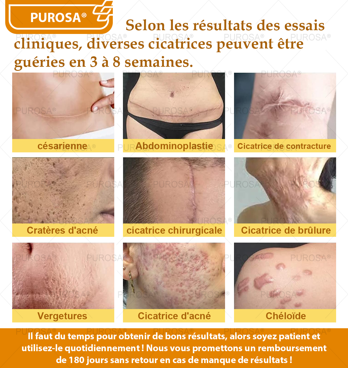 Limité à 10 pots seulement !🌟PUROSA®—Rabais exclusif de 30 %,retrouvez l’éclat jeunesse de votre peau en seulement 1 à 3 semaines!Une offre rare—elle ne reviendra pas avant l’an prochain,ne la manquez pas!💰Garantie de remboursement de 180 jours