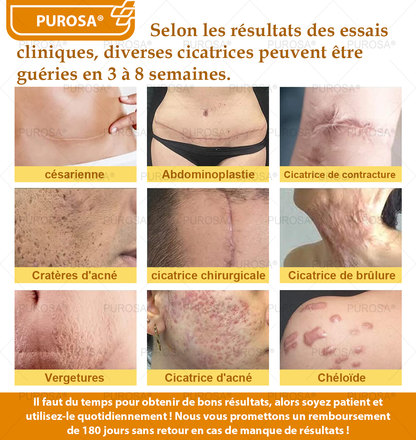 Limité à 10 pots seulement !🌟PUROSA®—Rabais exclusif de 30 %,retrouvez l’éclat jeunesse de votre peau en seulement 1 à 3 semaines!Une offre rare—elle ne reviendra pas avant l’an prochain,ne la manquez pas!💰Garantie de remboursement de 180 jours