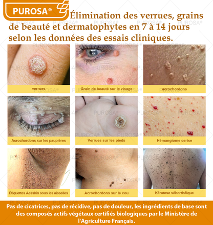 Limité à 10 pots seulement !🌟PUROSA®—Rabais exclusif de 30 %,retrouvez l’éclat jeunesse de votre peau en seulement 1 à 3 semaines!Une offre rare—elle ne reviendra pas avant l’an prochain,ne la manquez pas!💰Garantie de remboursement de 180 jours
