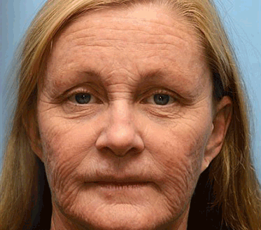 Limité à 10 pots seulement !🌟PUROSA®—Rabais exclusif de 30 %,retrouvez l’éclat jeunesse de votre peau en seulement 1 à 3 semaines!Une offre rare—elle ne reviendra pas avant l’an prochain,ne la manquez pas!💰Garantie de remboursement de 180 jours